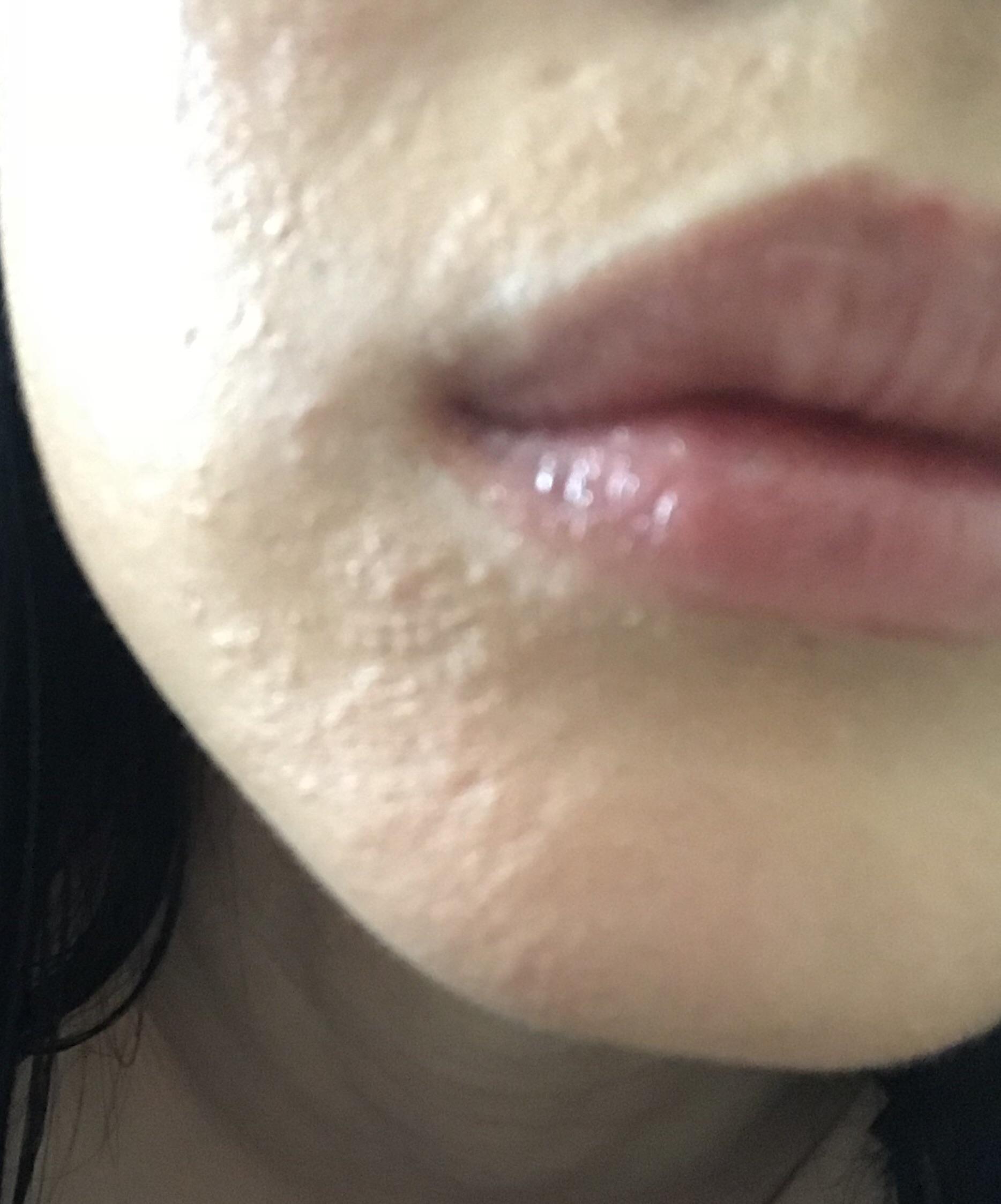 10mg accutane