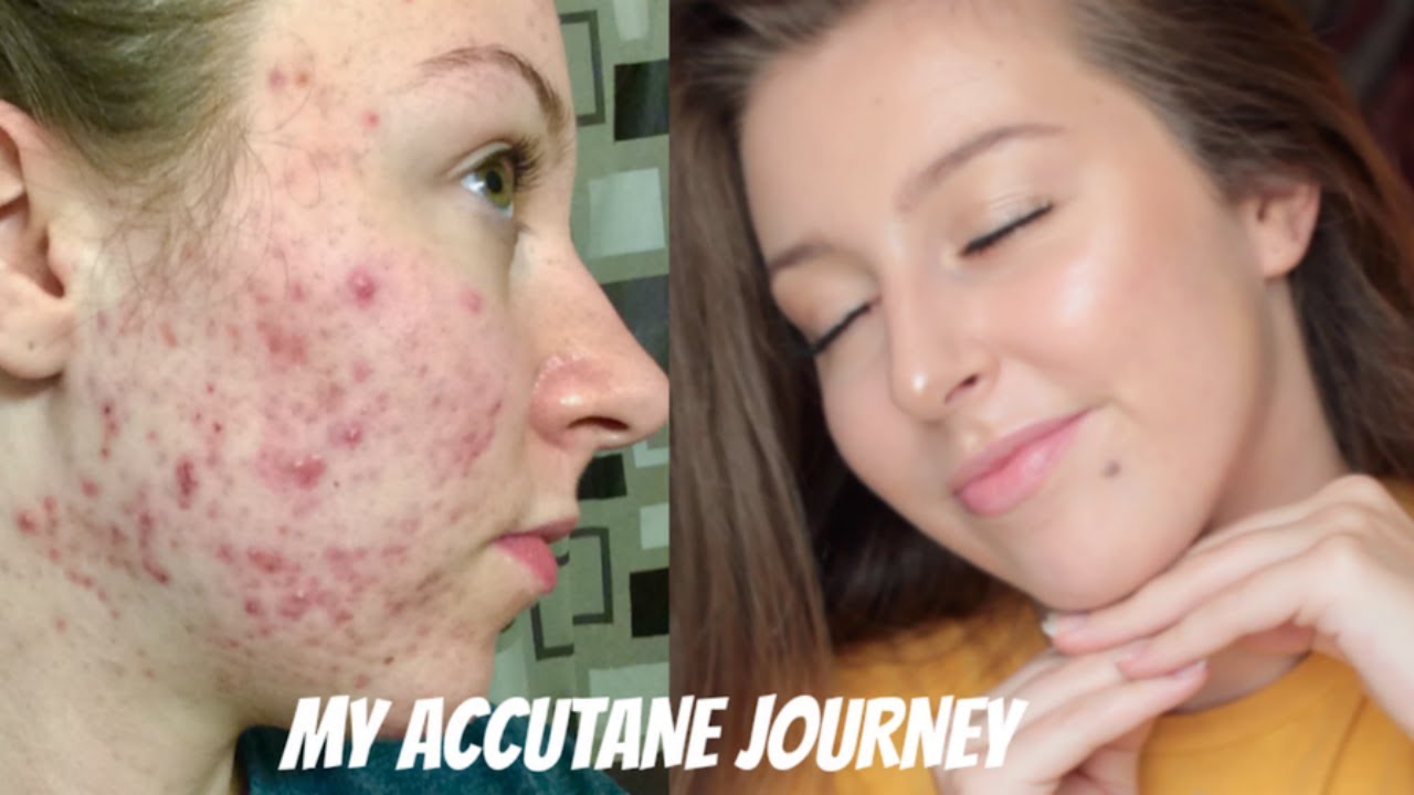 Accutane costs