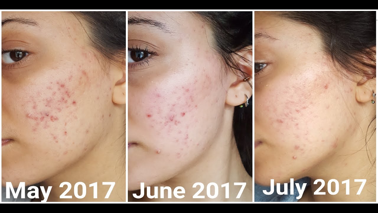 Accutane to buy uk