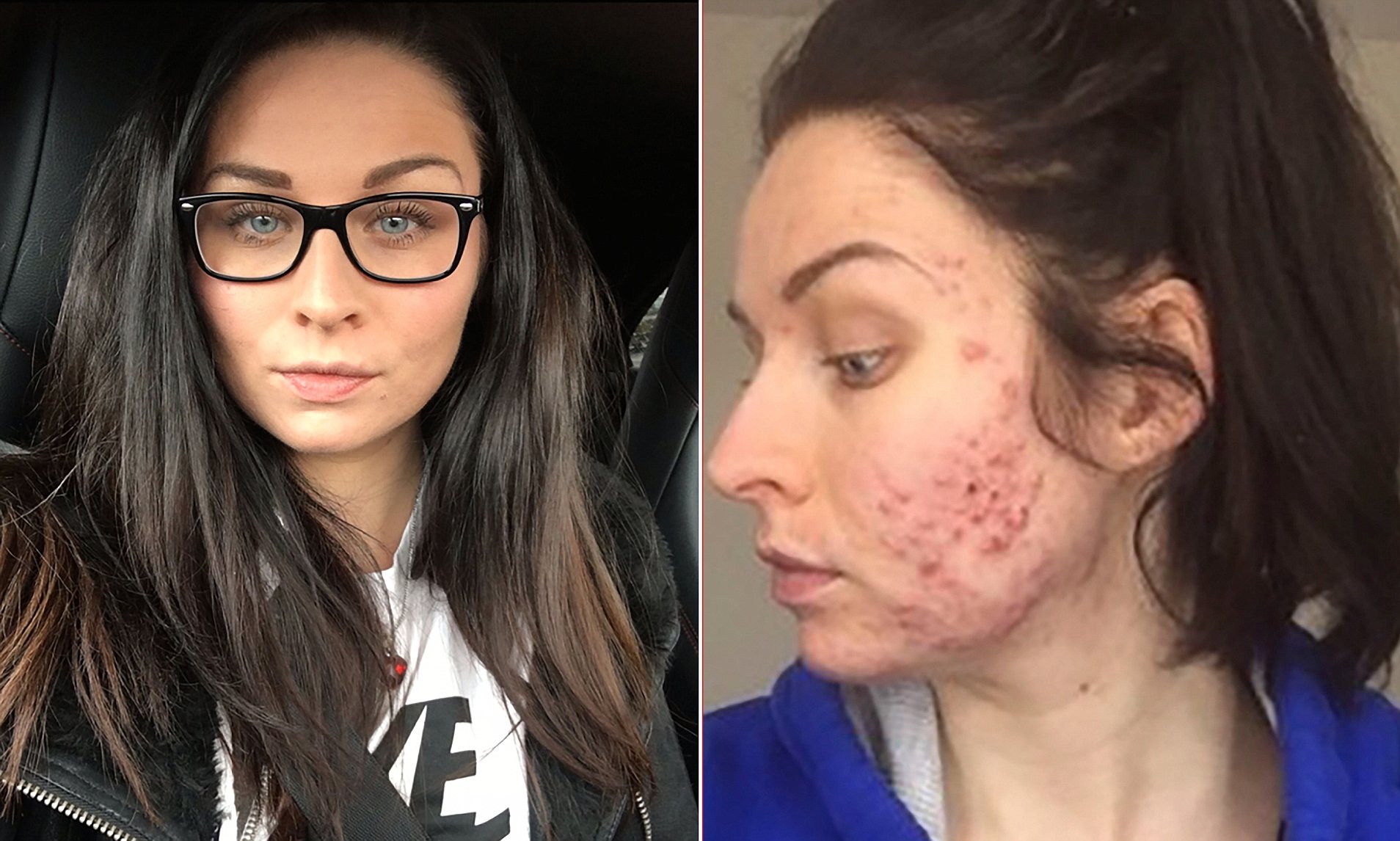 cost of roaccutane uk