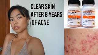 Buy zydex accutane