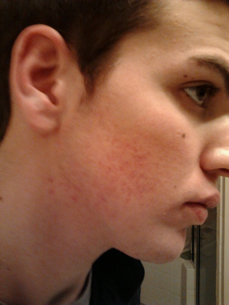 Accutane 80 Mg