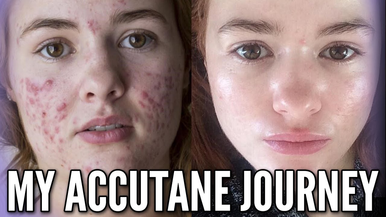 Cost Of Accutane In The Us