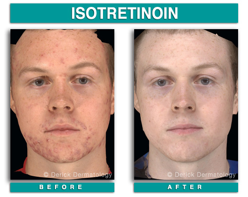 isotretinoin cheap