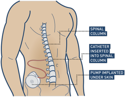 Cost of intrathecal baclofen