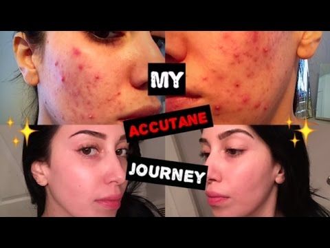 Accutane Buy Australia