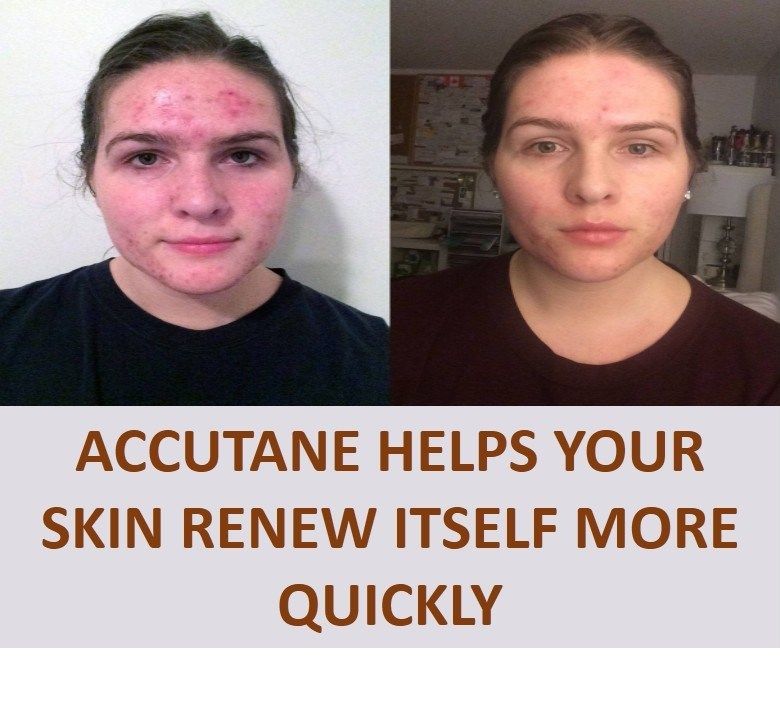 accutane buy canada