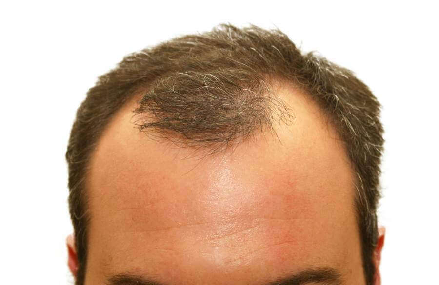 Finasteride Cost At Cvs