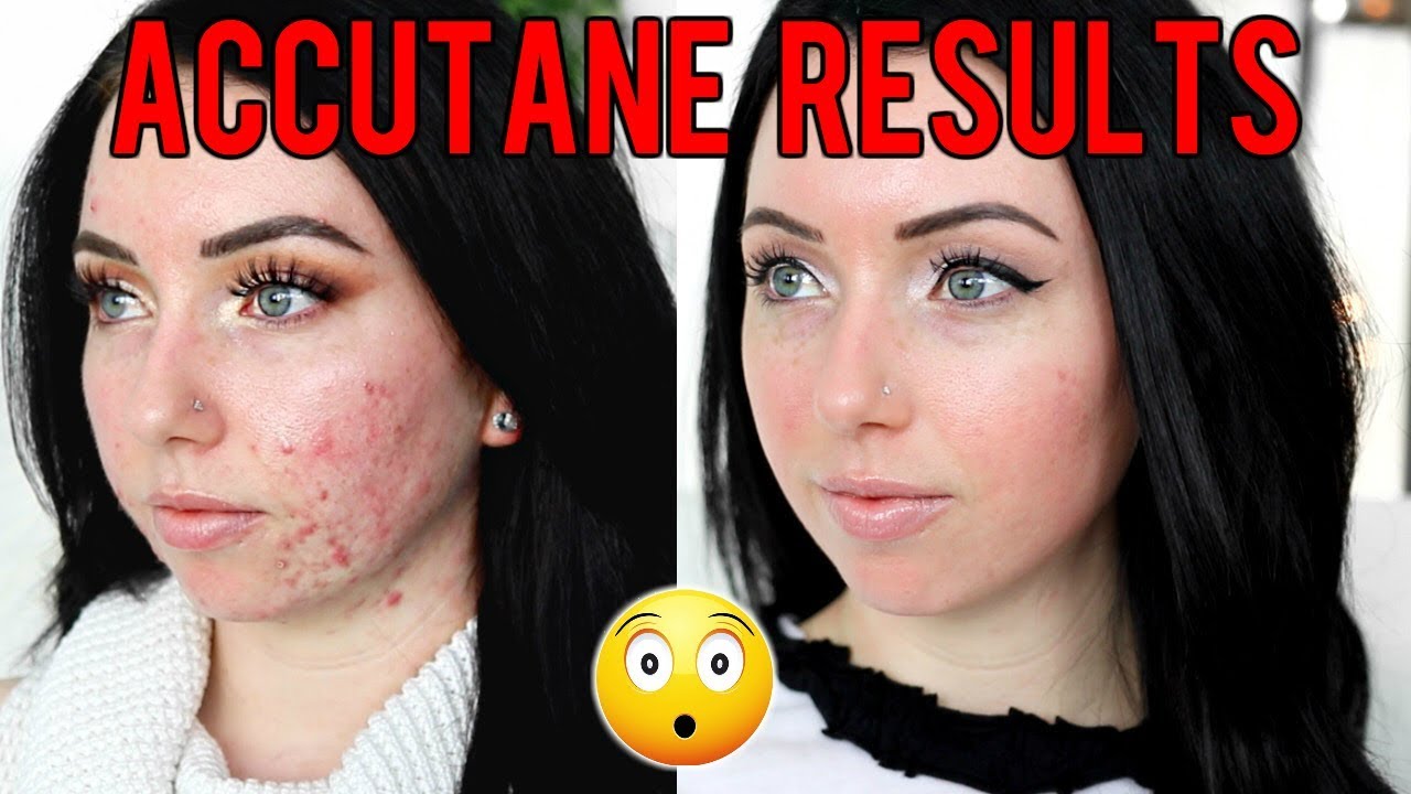 Cost of taking accutane