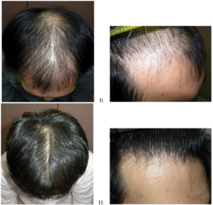 generic finasteride propecia