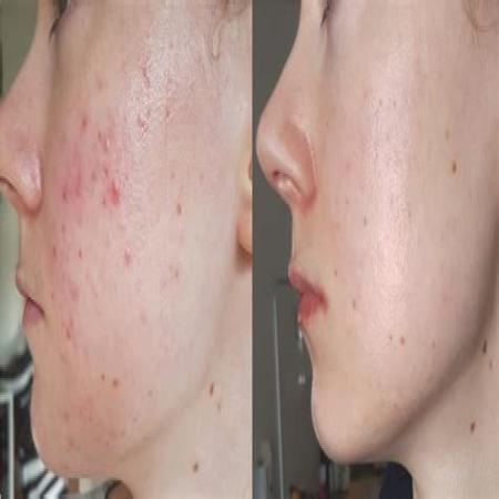 Roaccutane cost uk nhs